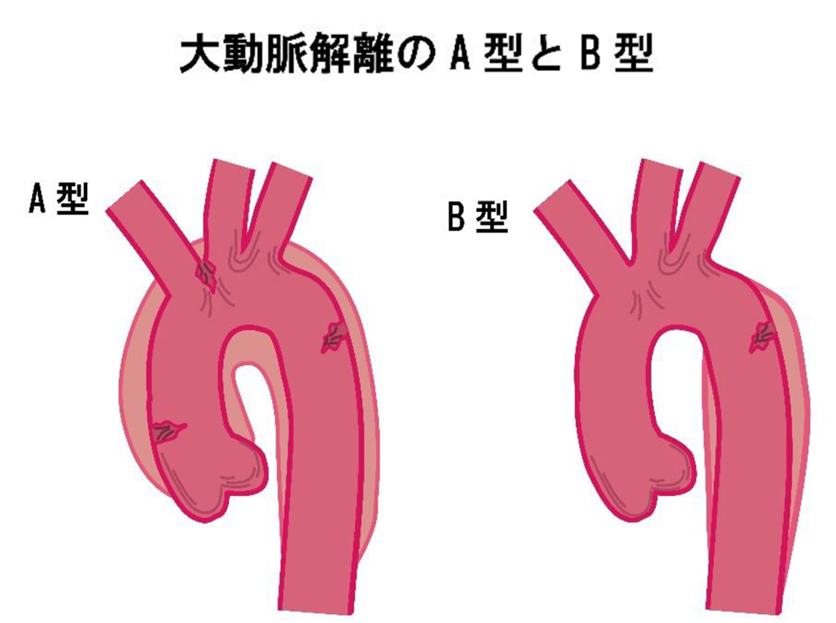 大動脈解離